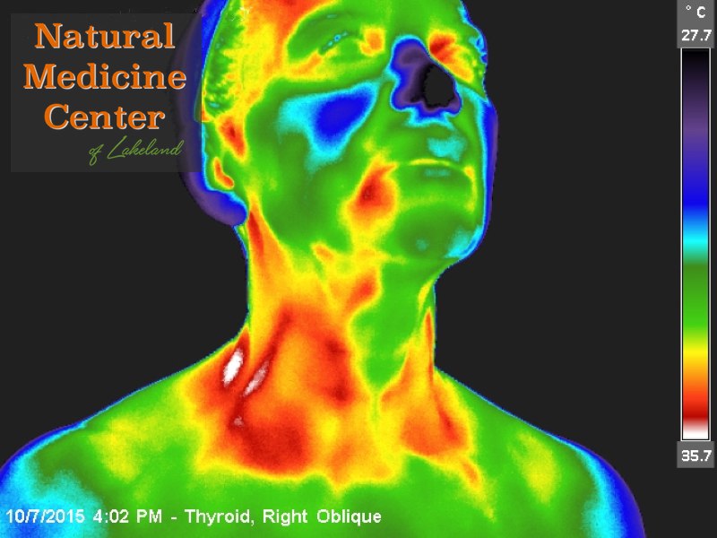 Thermography Abnormal Thyroid Detection Cancer Screening Thermographic ...